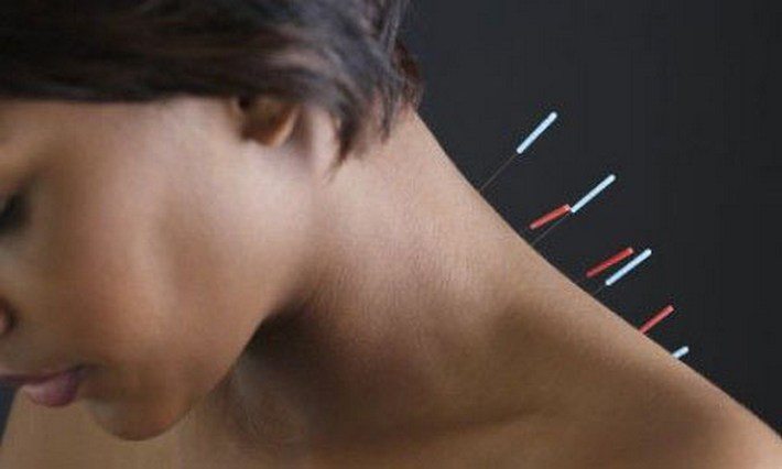 Иглоукалывание в лечении шейного остеохондроза Иглоукалывание